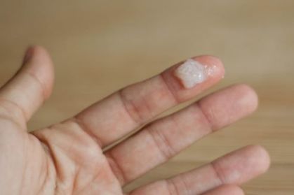 Khí hư vón cục màu trắng đục